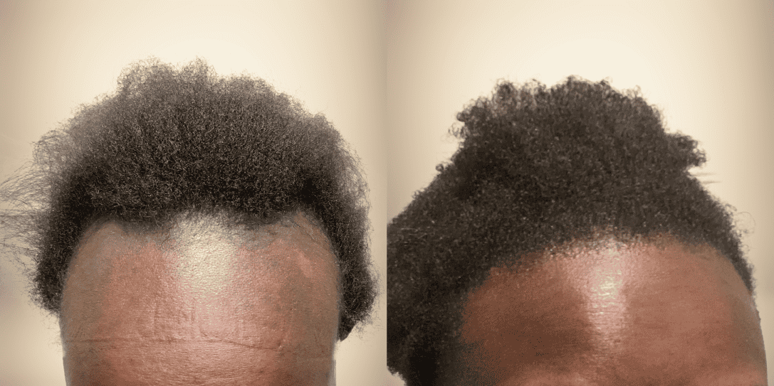 before-and-after-hair-restoration