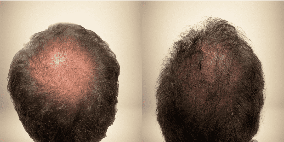 before-and-after-hair-restoration