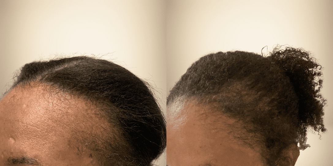 before-and-after-hair-restoration