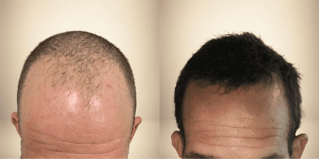 before-and-after-hair-restoration