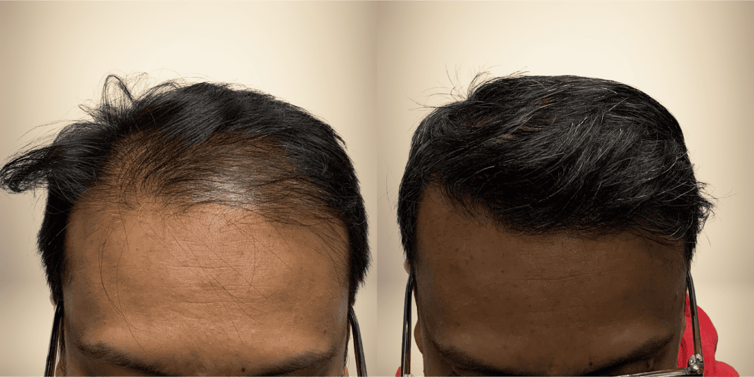 before-and-after-hair-restoration