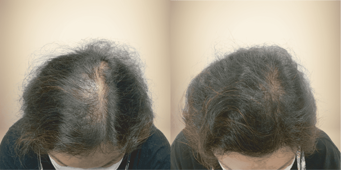 before-and-after-hair-restoration