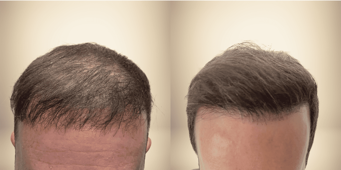 before-and-after-hair-restoration